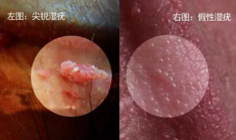 尖锐湿疣,病因、症状及防治策略