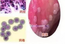 尖锐湿疣,病因、症状及防治策略