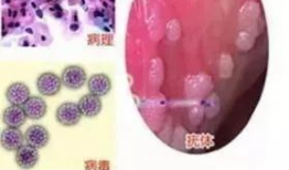尖锐湿疣,病因、症状及防治策略